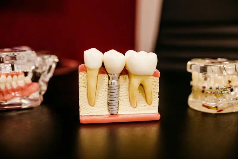 Protocolo sobre Implantes